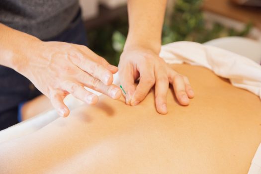 acupuncture pour lutter contre l'insomnie